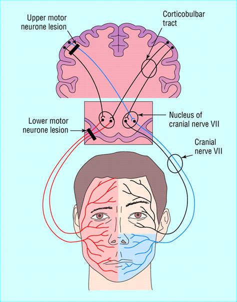 bell's palsy cranial nerve 5